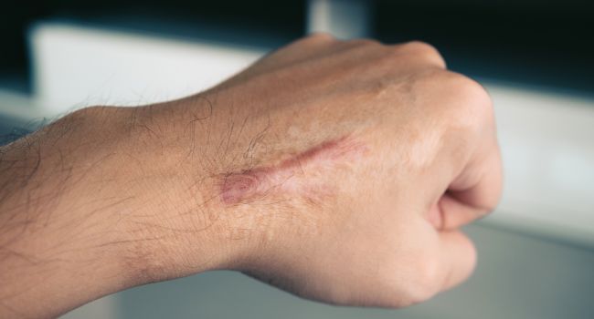 an image of scars