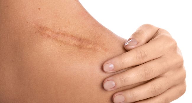 Teen self-harm scars